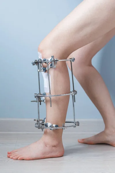 Fixateur externe